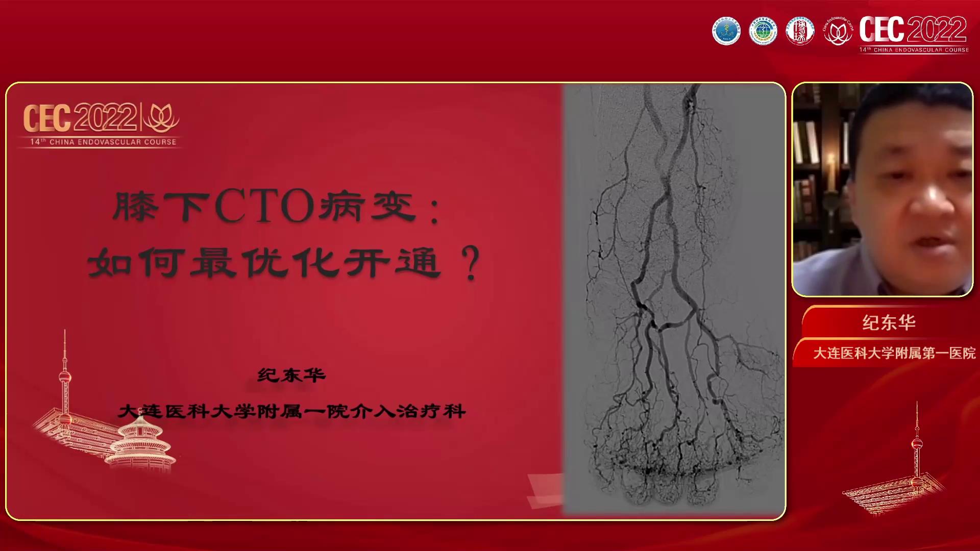 膝下CTO病变如何优化治疗-纪东华图片